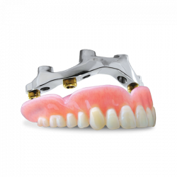 DentureWithOverbar-Allon4